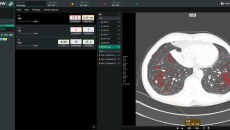 Interface of Coreline Soft's AI-powered chest X-ray analysis software