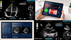 Ultromics, ultrasound, AI, dianostics, Caption Health