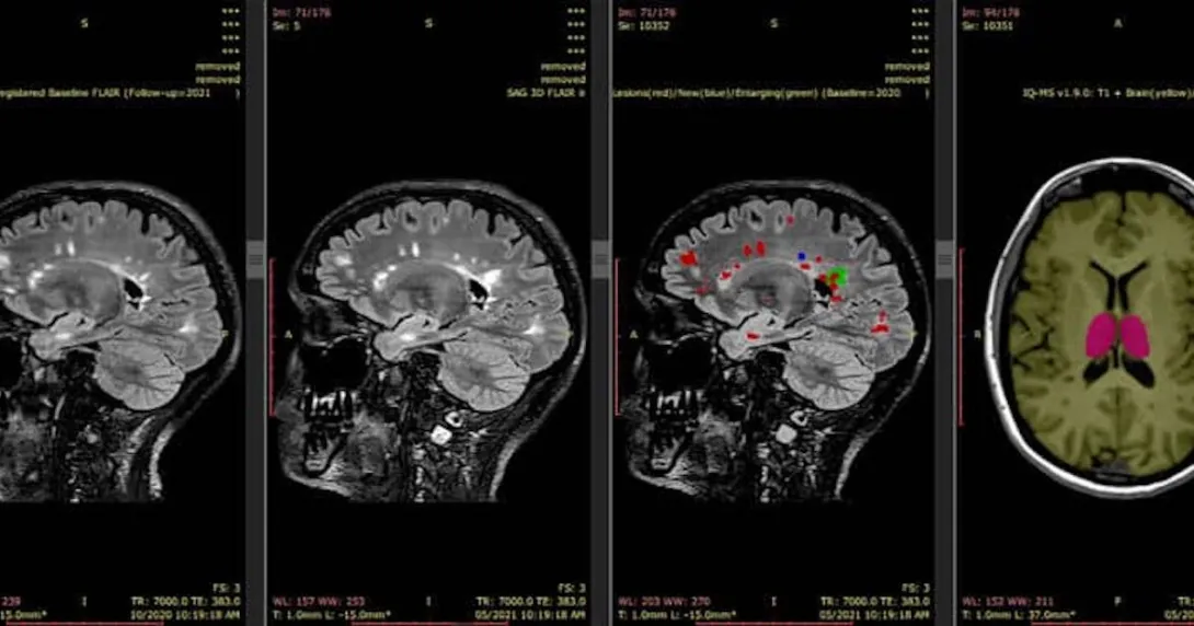 Automatic MRI scan analysis report generated by SNAC's AI-based platform iQ-solutions