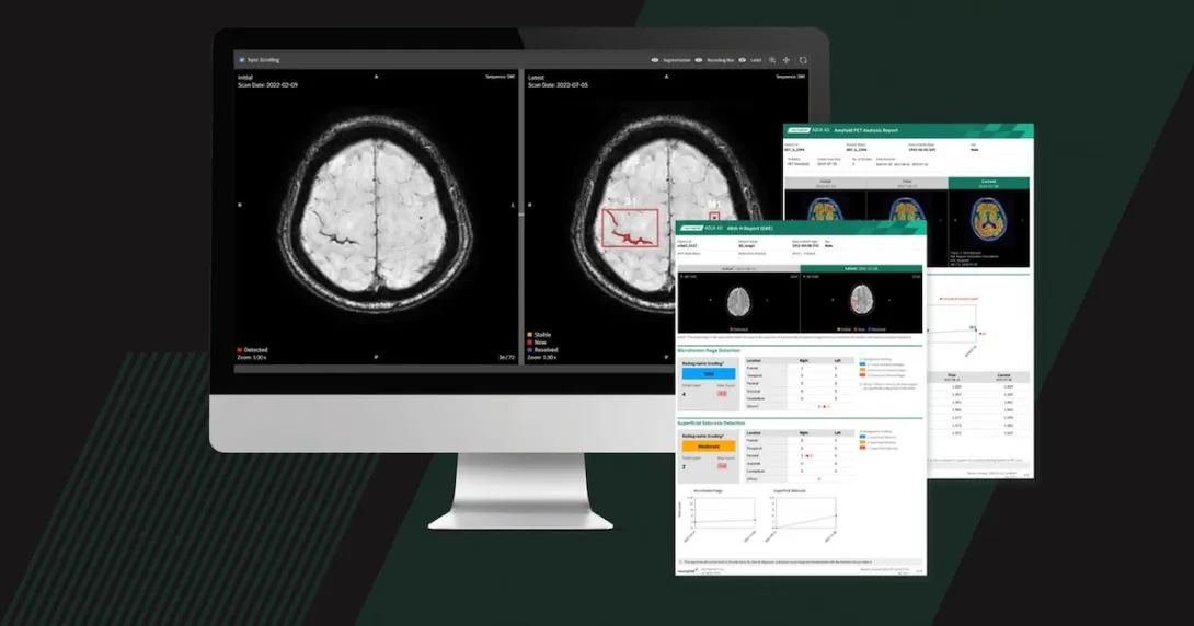 Neurophet's AI-powered Alzheimer's disease image analysis software