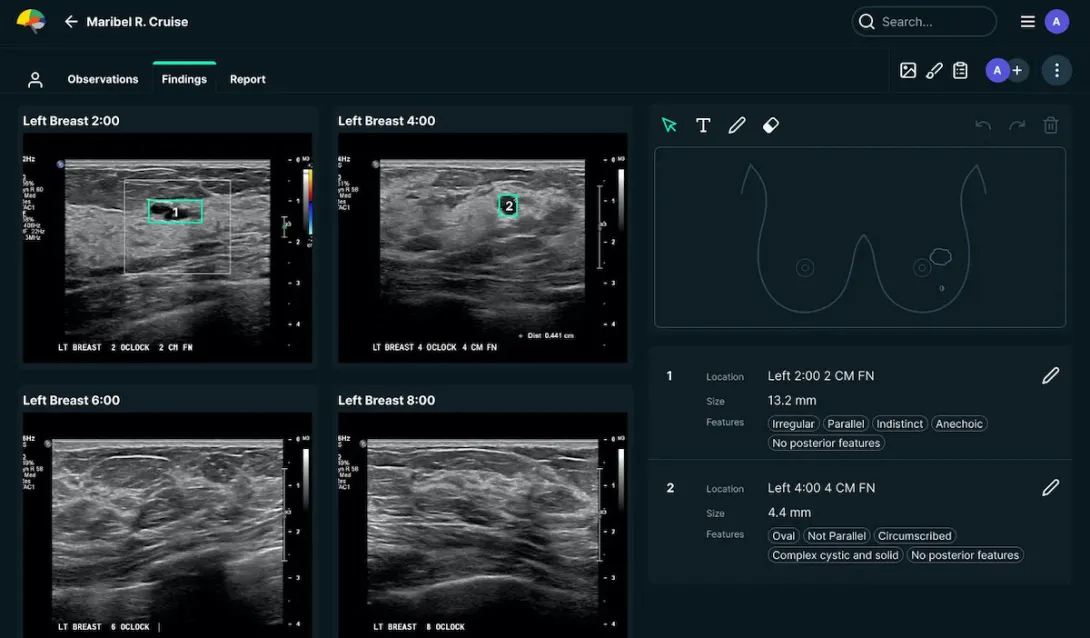 Breast scan analysis via See-Mode software