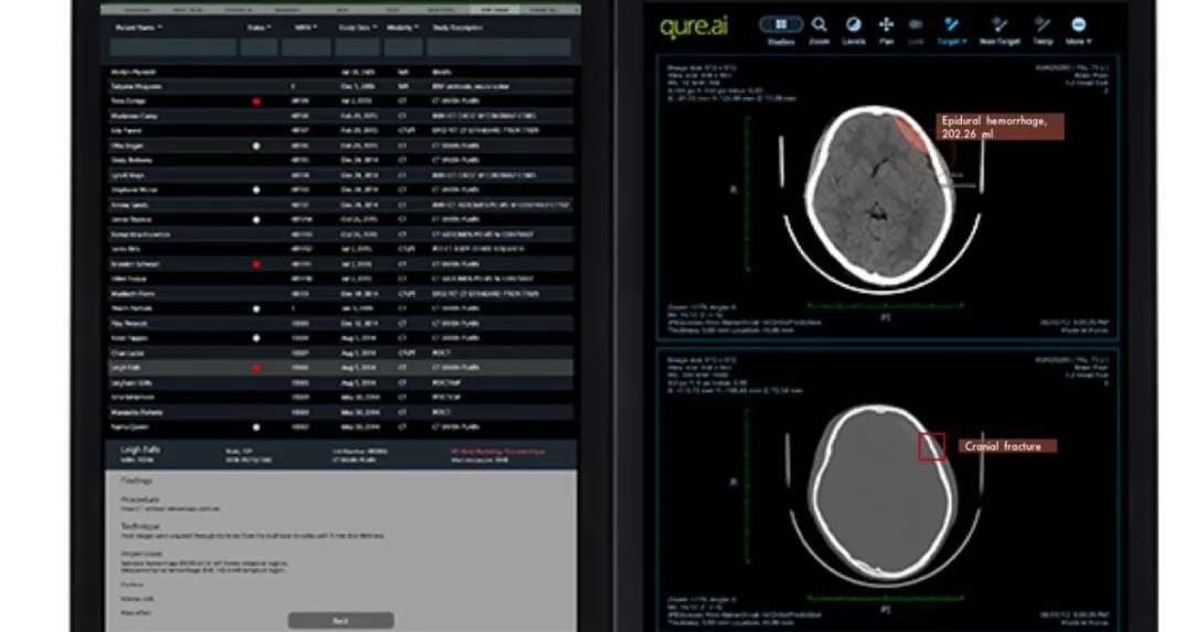 Desktop view of the Qure.ai Stroke Management Platform